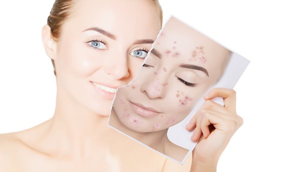 Akné netrápi len pubertiakov