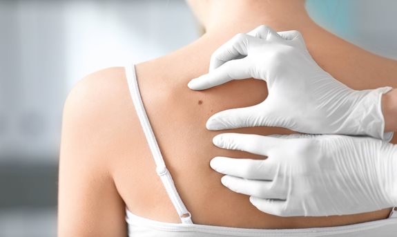 Materské znamienka ako skryté nebezpečenstvo